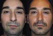Nose Job in Dubai