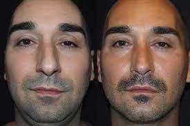 Nose Job in Dubai