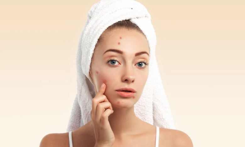 How Long to Leave Pimple Patch On: The Right Way to Use It for Best Results
